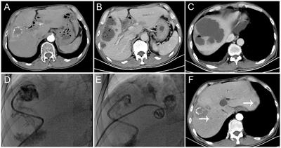 The impact of liver abscess formation on prognosis of patients with malignant liver tumors after transarterial chemoembolization